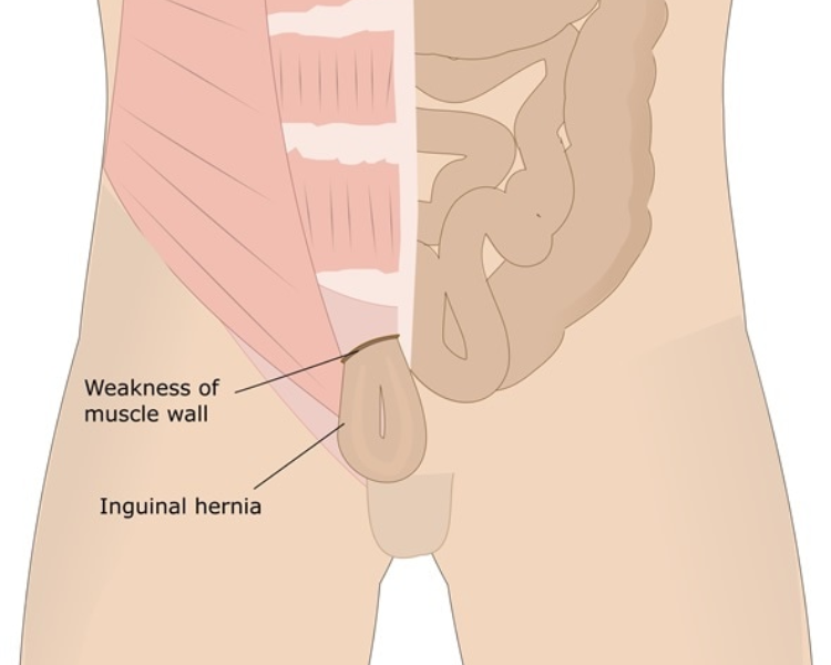 hernia surgery cost in hyderabad