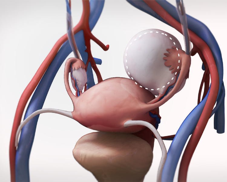 Laparoscopic Ovarian Cystectomy Procedure Steps