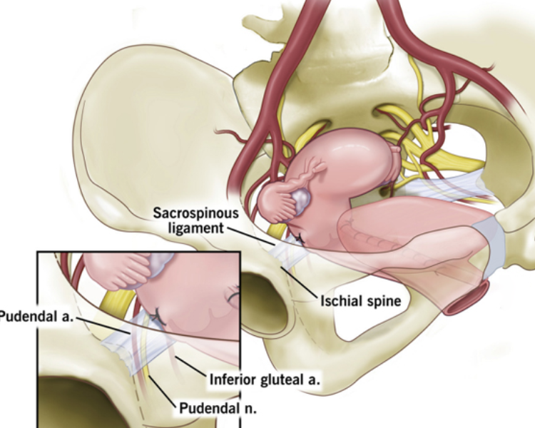 Prolapse-surgeries